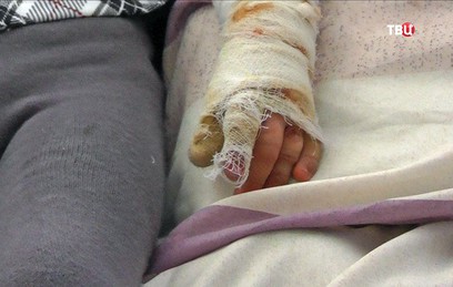 Получившую ожоги в самолете Тунис - Москва девочку прооперировали