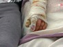 Рука пострадавшего ребенка Рука пострадавшего ребенка
