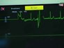 Показатели сердечного ритма на кардиомониторе Показатели сердечного ритма на кардиомониторе
