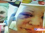 Москвичка, потерявшая зрение после процедуры подтяжки век Москвичка, потерявшая зрение после процедуры подтяжки век