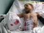 Пострадавший мальчик при обстрела жилых районов Донбасса Пострадавший мальчик при обстрела жилых районов Донбасса