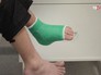 Пациент после проведенной операции на ступне Пациент после проведенной операции на ступне