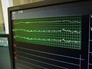 Показатели сердечного ритма на кардиомониторе Показатели сердечного ритма на кардиомониторе