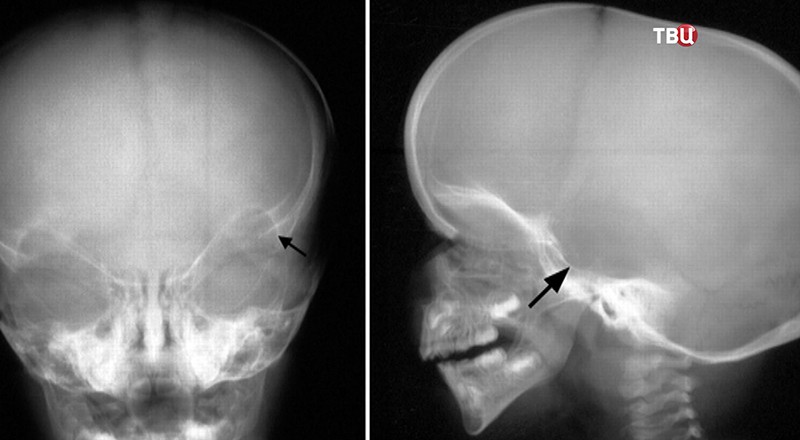 Рентген-снимок головы ребенка