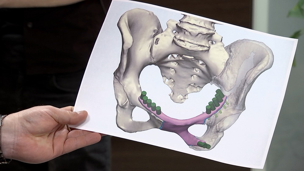 Модель импланта тазовой кости