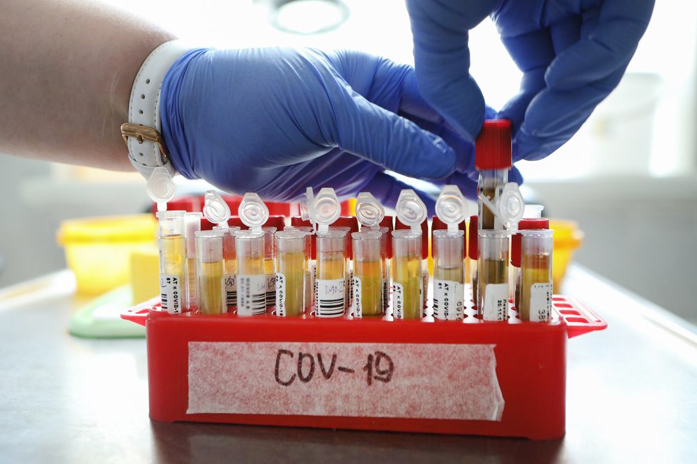 Тестирование на антител к коронавирусу